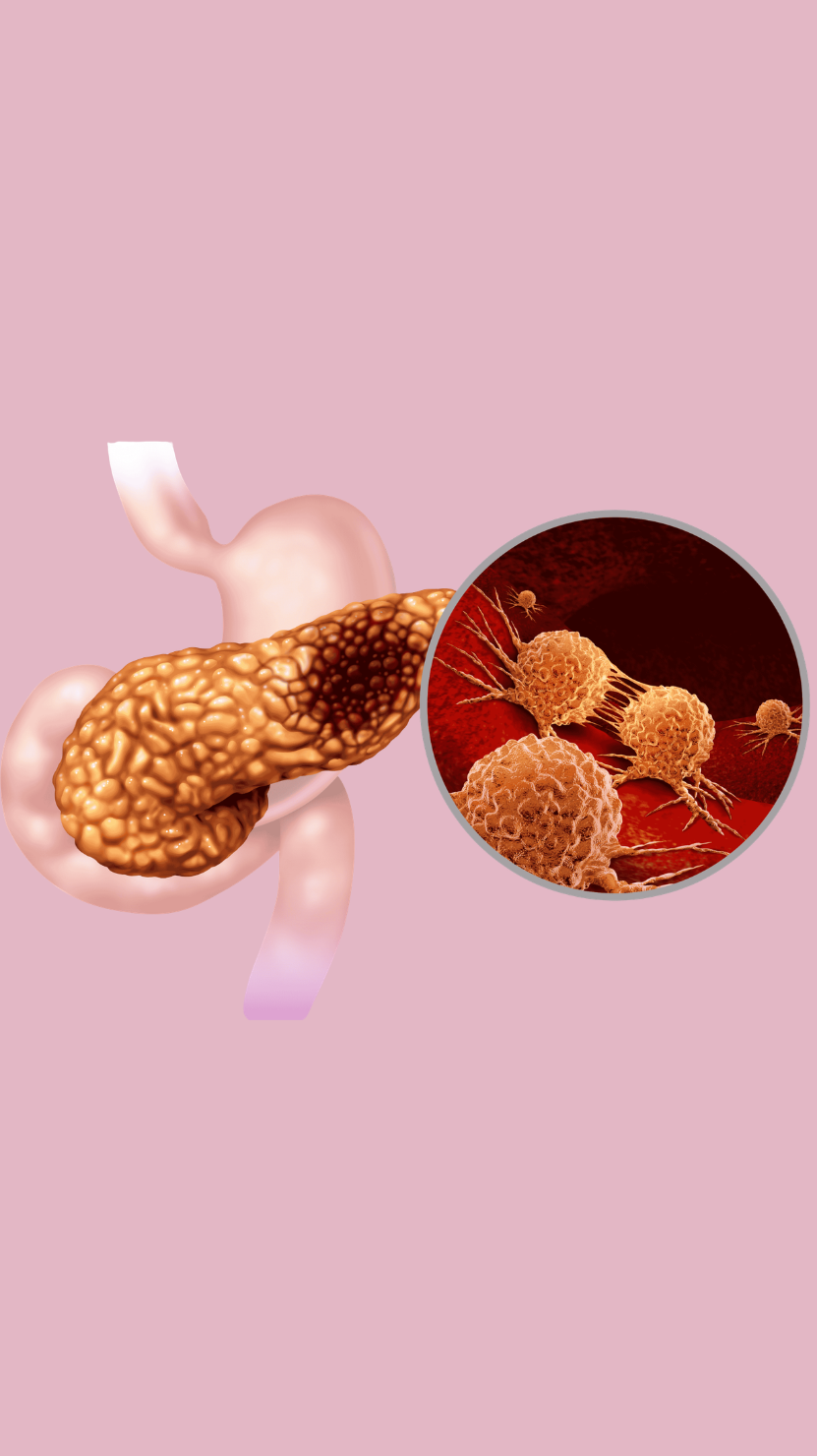 Laparoscopic Whipple procedure advanced pancreatic surgery at AnuSri Hospitals Secunderabad Hyderabad
